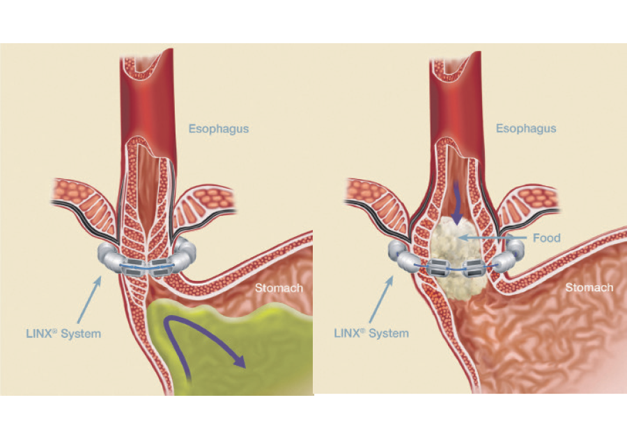 Баллонная кардиодилатация. Спазм сфинктера операция. Сфинктер одди анатомия человека. Пневмокардиодилатация при ахалазии. Ахалазия пищевода баллонная дилатация.