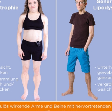 Lipodystrophie: Fett, wo es nicht hingehört – Beitrag von Amryt