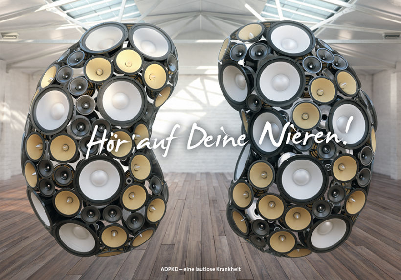 Eine lautlose Krankheit: ADPKD lässt die Nieren immer größer werden. Eine lautlose Krankheit: ADPKD lässt die Nieren immer größer werden.