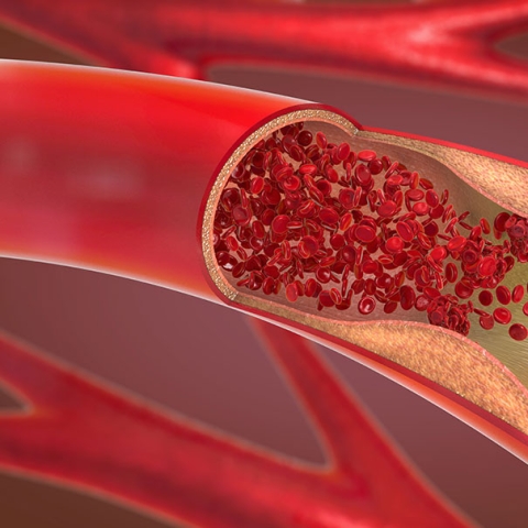 Bei einer Atherosklerose kommt es zu Ablagerungen in den Blutgefäßen, die den Blutfluss behindern können.