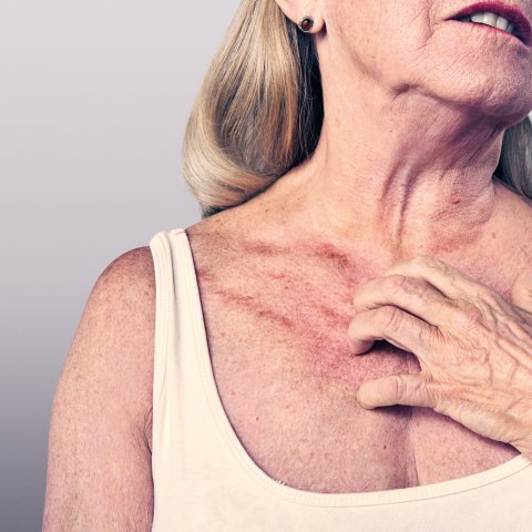 Juckreiz ist eine häufige Begleiterscheinung bei Hämodialyse-Patienten.